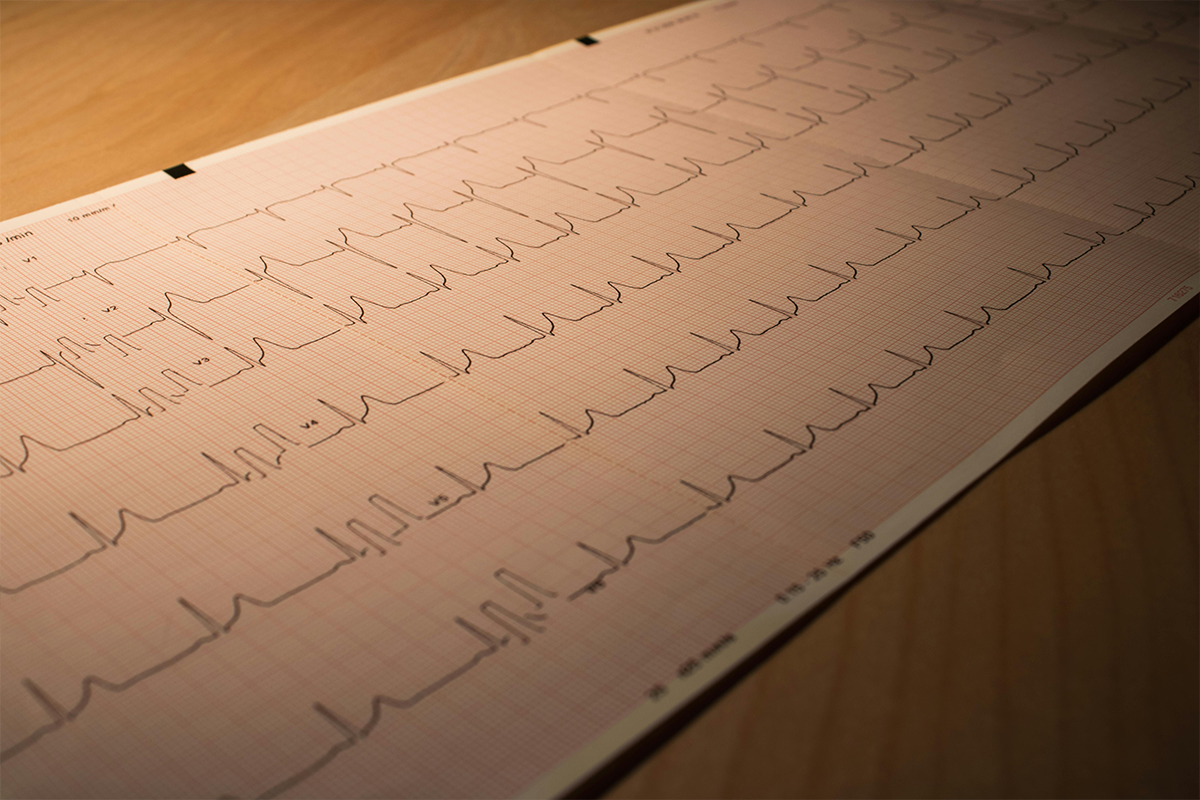 Die Auswertungen eines EKGs.